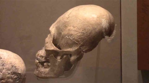 Ancient elongated skulls of Mexico and the mystery behind their shape