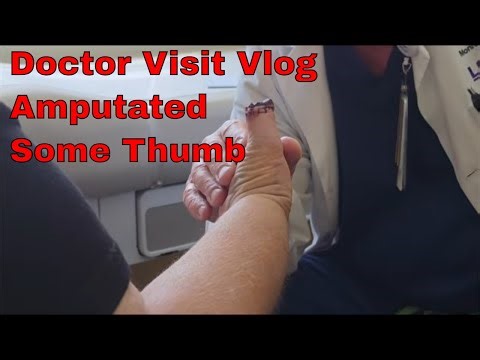 Post OP Dr. Visit For Amputated Thumb * Vlog * Raynaud's