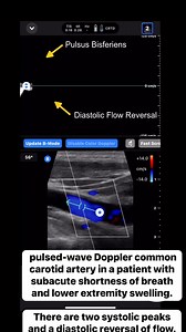 221K views · 1.4K reactions | This is a pulsed-wave Doppler tracing...