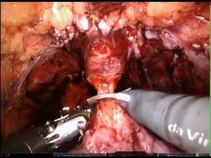 Bilateral Nerve Sparing Robotic Radical Prostatectomy • Video • MEDtube.net