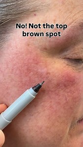 🔎✨ The Power of Mole Mapping This video shows a 1mm malignant melanoma in situ found on the cheek of a 51-year-old woman. It was identified early thanks to mole mapping and video dermoscopy – tools that allow us to track even the tiniest changes in your skin over time. ➡️ How mole mapping works: 📸 Full-body photography creates a baseline record of your skin. 🔁 At follow-ups, new images are compared side-by-side with previous ones. 👀 Suspicious changes in spots, moles, or freckles can be dete