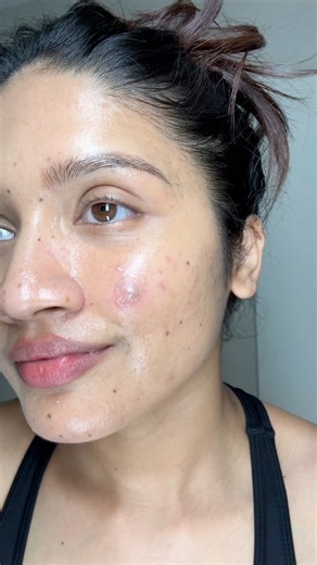 Remember this cyst? 👀🩹 Here’s the healing update, 5 patches later and it’s almost gone! ✨ | Skincare Mamata