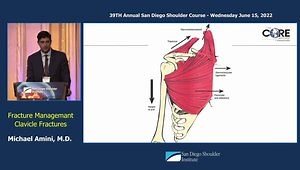 Fracture Management: Clavicle Fractures
