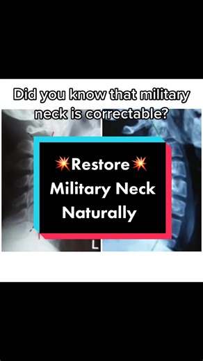 Restoring Cervical Lordosis Through Exercise Protocol