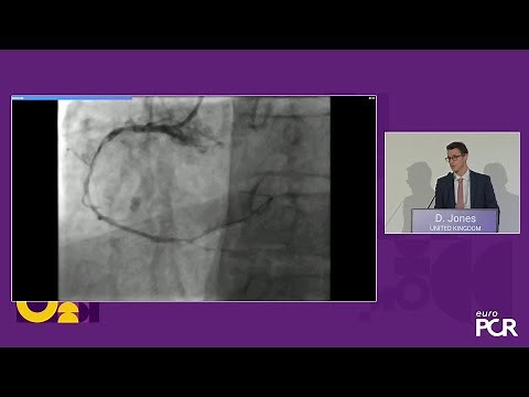 Treating complex CAD indications with sirolimus coated balloon: evidence and performance - EuroPCR