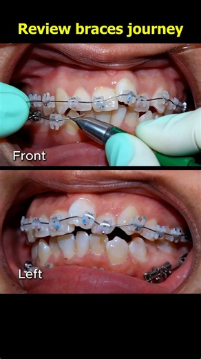 Review 26 months braces journey. From crooked teeth to straight teeth #braces #orthodontics #bracket