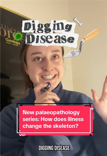 Digging Disease Episode 1 🦠 When I’m not analysing gold and ceramics, I’m writing about archaeological smallpox, so I thought I’d turn it into a video series #palaeopathology #diggingdisease #history #archaeology #pathology Some useful intro reads for palaeopathology (most available online): • Identification of pathological conditions on the human skeleton, Ortner • Palaeopathology, Waldron • A companion to palaeopathology, Grauer • Palaeopathology of children, Lewis