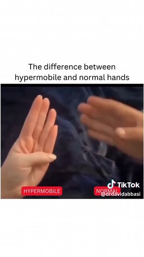 Understanding Joint Mobility: Hypermobility vs Limited Mobility