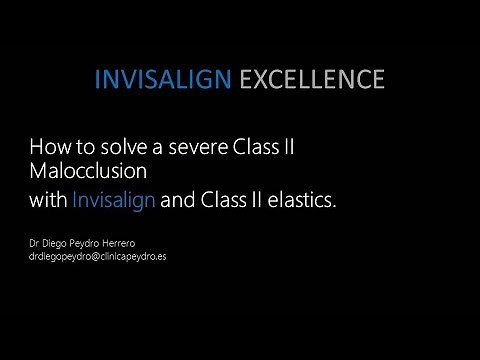 Invisalign Tips: How to solve a severe Class II with Invisalign and class II elastics