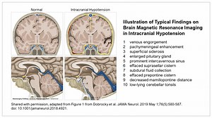 Let's make misdiagnosis the exception - Spinal CSF Leak Foundation