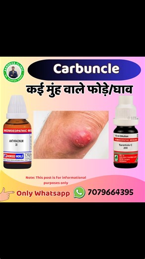 Best Homeopathic medicine for carbuncle #health #healthcare #healthylifestyle #healthtips #healthyfood #carbuncle #acid #doctor | Dr. Deepak Singh