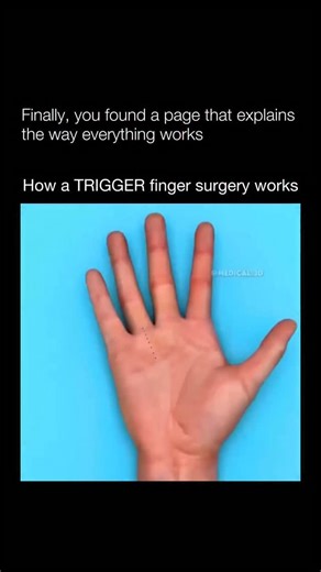 The Way Everything Works on Instagram: "Trigger finger surgery is a simple and highly effective procedure used to restore smooth finger movement when a tendon becomes stuck or locked. The condition happens when the A1 pulley — a fibrous band at the base of the finger — thickens or becomes inflamed, preventing the tendon from gliding freely and causing pain, clicking, or locking. During the procedure, the hand is numbed with local anesthesia and a small incision is made at the base of the affecte
