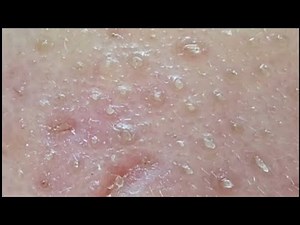 Popping My Own Pimples | Sebum Squeeze & Self-Extraction #59 #sebum #acne #pimple #pimplepopping