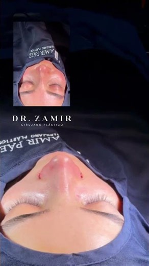 Antes y después de una rinoplastia ultrasónica | Dr. Zamir Páez