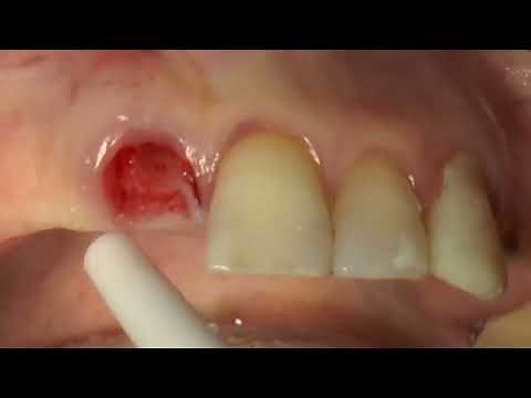 Immediate implant placement using the Neodent implant system.