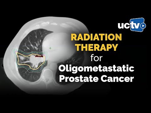 Radiation Therapy for Oligometastatic Prostate Cancer