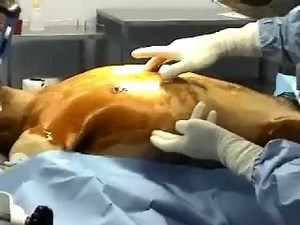 Ponction Biopsie Hépatique (PBH)