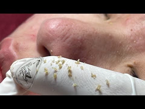 Acne On Nose - Acne Treatments Mai Ngoc 💕💕💕