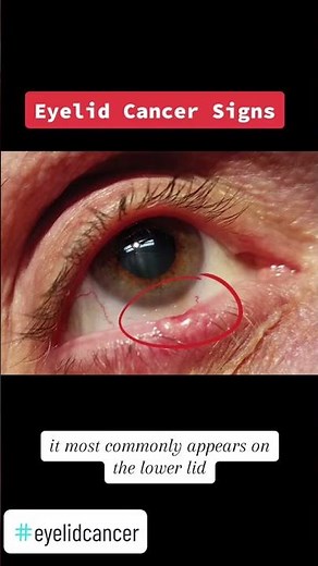Is Your Eyelid Trying to Tell You Something? 5 Warning Signs of Eyelid Cancer #eyes #cancer