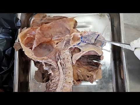 Nose Dissection | Parts | Relations | Applied Anatomy
