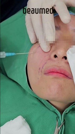 PLA (Poly-L-Lactic Acid)+HA filler