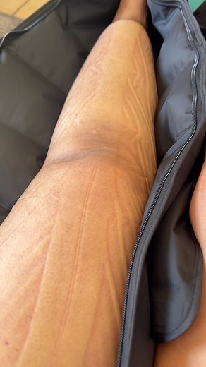 45K views · 428 reactions | You can drain your lymphatic system with self-lymph drainage (SLD) massage, which involves gently massaging areas to move extra fluid from swollen areas to areas where lymph nodes are functioning properly. Your lymphatic system is a network of tissues and organs that help rid your body of waste | Mimo Madimo Mokgosi | Facebook