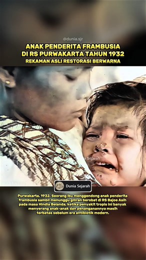 Pasien Anak Penderita Frambusia Era Kolonial 1932 #sejarahindonesia #hindiabelanda #hindiabelanda