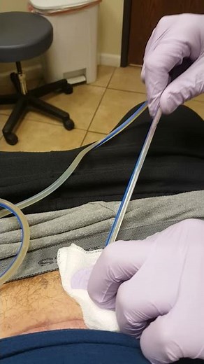 Surgical Drain Removal - GRAPHIC