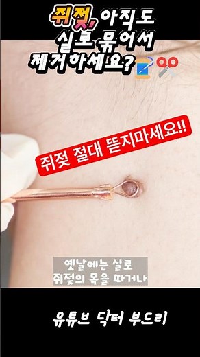 From the Causes of Skin Tag Removal to Scar-Free Removal (feat. Erbium YAG Laser)