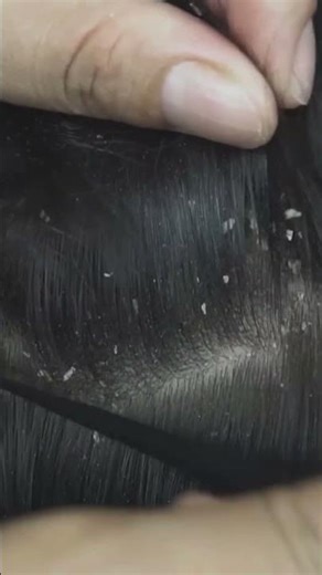 Quick and Easy Removing Scratching Big Dandruff Flakes