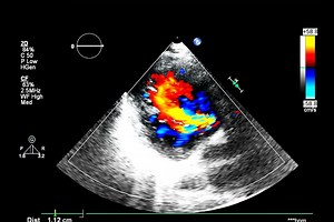 What is the colour Doppler echocardiogram?