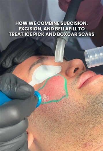 Treating ice pick and boxcar scars requires precision and the right combination of tools for each specific scar type. Some scars are simply too stuck and clustered to respond to lifting alone. In those cases, we need to physically break them up or remove them entirely to create real change. For this particular scar, I marked it as a candidate for excision. It is a wide, deep boxcar scar that would not lift enough with subcision alone. By excising it on the lateral cheek where tension is minimal,