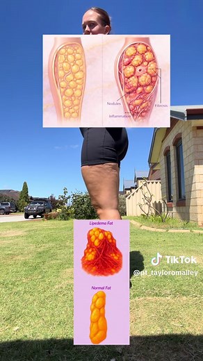 Understanding Lipedema: The Hidden Condition Mistaken for Obesity