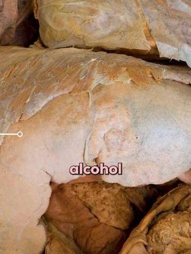 ⚠️ Both alcohol and THC affect the body long-term — but the way they cause damage couldn't be more different. Alcohol causes direct, progressive organ damage. The liver metabolizes alcohol into acetaldehyde — a byproduct that's actually more toxic than the alcohol itself — triggering inflammation and oxidative stress. Over time this leads to fat accumulation → inflammation → scar tissue → fibrosis → cirrhosis, where liver structure and function become severely impaired. The pancreas and stomach
