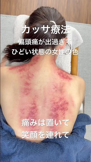 【偏頭痛の取れない女性にカッサ療法】