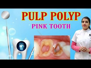 Pulp polyp | Chronic Hyperplastic Pulpitis | proliferative pulpitis | treatment of pulp polyp |