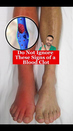 Do not ignore these 8 signs of a blood clot also known as a Dee vein thrombosis (DVT). It usually occurs mostly just on one leg. The signs include 1)Change in color, 2)Swelling, 3)Warm skin, 4)Pain, 5)Difficulty in breathing, 6)Leg cramp, 7)Pitting edema, 8)Swollen & painful veins. It can cause a pulmonary embolism if the clot breaks off and travels through to bloodstream to your lungs. Always see your doctor to get checked up. #fyp #medical #bloodclot #dvt #viral