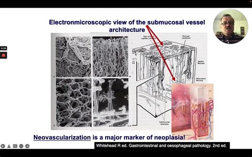 Early Gastric Cancer: Yao Classification and Basic Principles of Endoscopic Inspection > Basic Principles > Angiogenesis > Endoscopic Detection > Yao Classification Watch the full lecture on EndoCollab | EndoCollab
