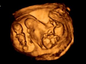 3D ultrasound. Dichorionic triamniotic triplets 12 weeks.
