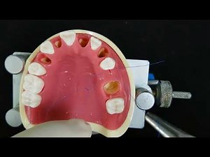 Back to the suture - Sentineri Modiflied Laurell suture