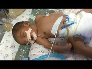 Medical Education Video: Neonatology: Gasping respiration of newborn on ventilator