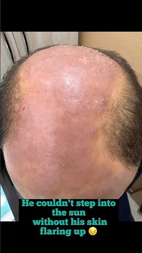 Polymorphic Light Eruption (PMLE) | Severe Sun Allergy Treated WITHOUT Steroids | 4 Month Results