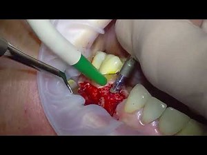 Guided Dental Implant Placement