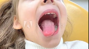 Close-up of little girl opening her mouth wide to the doctor to show her throat. Child is sitting with wide open mouth, with a tongue stuck out, clear view on the uvula and the soft palate