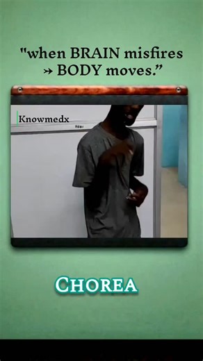 KnowMedx on Instagram: "Chorea is a movement disorder characterized by involuntary, irregular, sudden, non-rhythmic movements that appear to flow from one body part to another. 🟢 🔹 Key Features Jerky, dance-like movements Unpredictable & purposeless Involves face, hands, feet, trunk Movements disappear during sleep Worse with stress or excitement (Chorea disease Health care Explore page Trending videos) #chorea #exploreknowmedx #health#instagramreels#indiareels❤️"