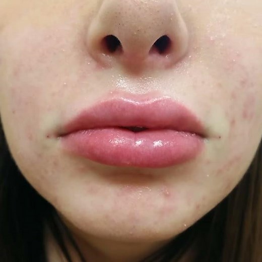 Restylane Lip Injection/Lip Augmentation by Dr. Lebowitz, Long Island, New York.