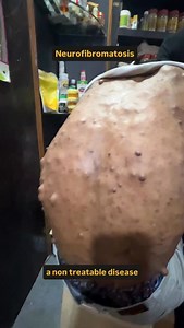 Neurofibromatosis is a group of genetic conditions that cause tumors to grow on the nervous system, though most are non-cancerous. The most common types are Neurofibromatosis 1 (NF1) and Neurofibromatosis 2 (NF2), which are distinct genetic disorders, along with a rarer form called schwannomatosis. Symptoms vary but often include skin changes like light brown spots and tumors that can affect the skin, spinal cord, and brain. | DrChandrakumar Deshmukh