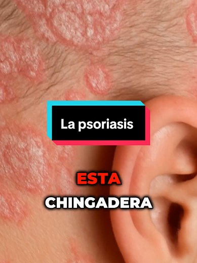 Entiende la Psoriasis y su Impacto en la Salud