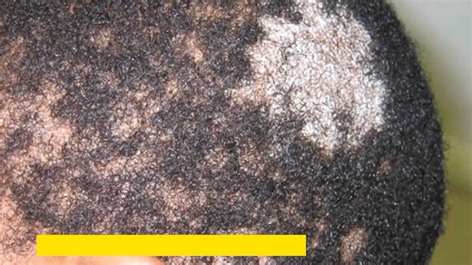 Natural remedy for ringworm | Good living Ghana