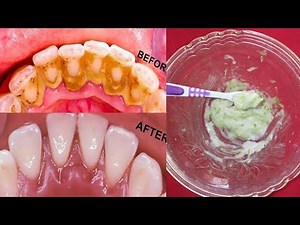 How to Remove Dental Plaque 3 Minutes Naturally with this Recipe, Without Going To The Dentist